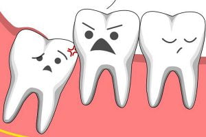 Mọc răng khôn có nhất thiết phải nhổ không? Lưu ý sau khi nhổ