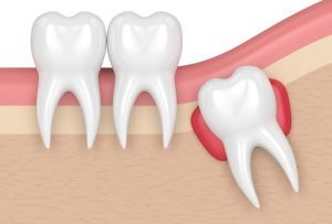Mọc răng khôn làm gì cho bớt đau? Vì sao cần nhổ bỏ răng khôn