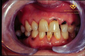 Sâu răng lan nhanh là gì? Đâu là giải pháp điều trị dứt điểm?