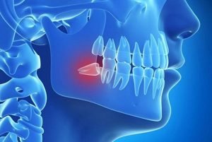 Lưu ý nhổ răng khôn – Những kinh nghiệm bạn cần biết