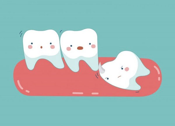 Mọc răng khôn rất đau gây ra biến chứng gì?
