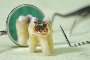 Sâu răng mặt ngoài – Nguyên nhân và cách điều trị hiệu quả
