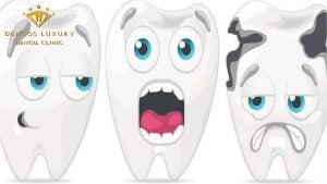 Sâu răng số 36 nên nhổ khi nào, ảnh hưởng gì không?