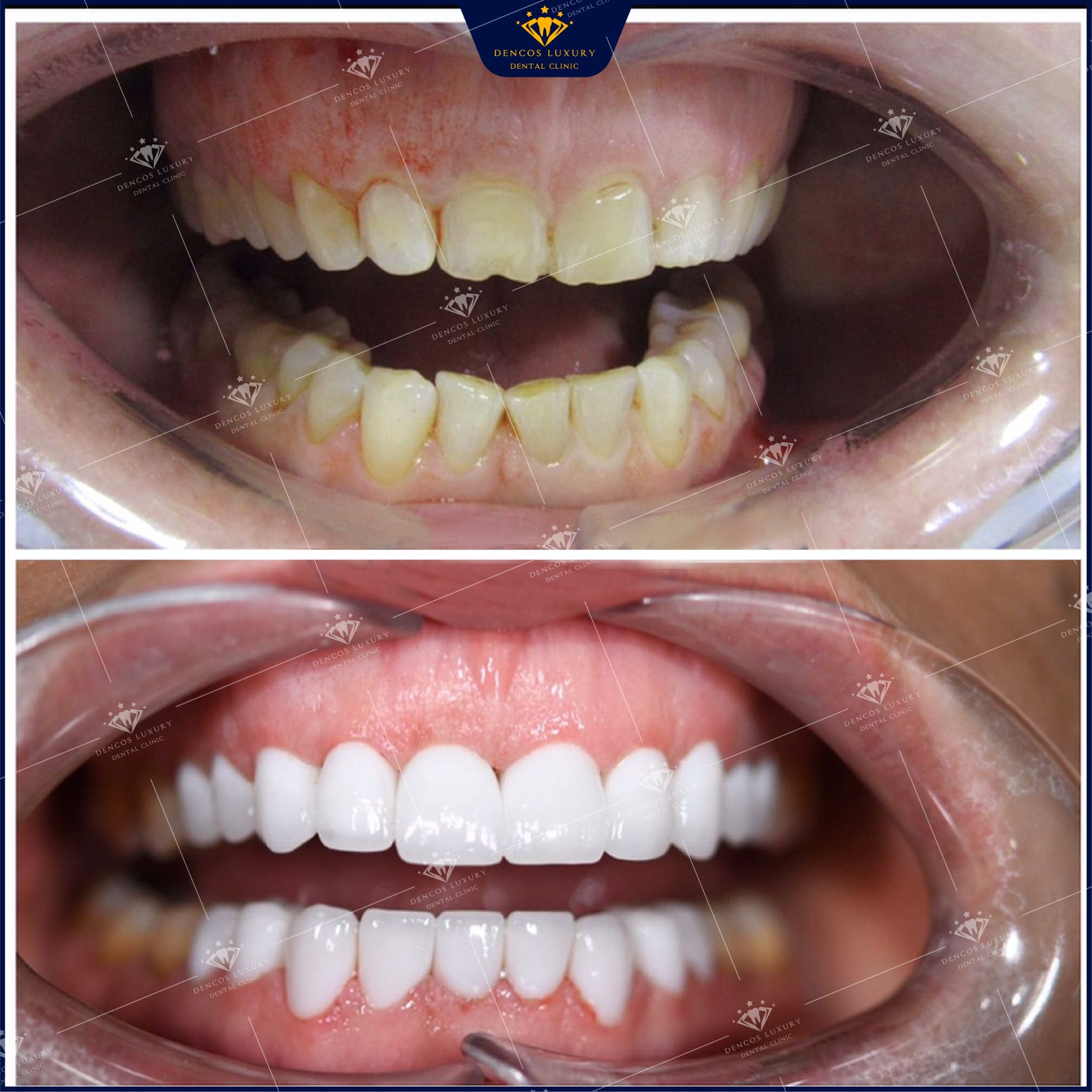 dán sứ veneer