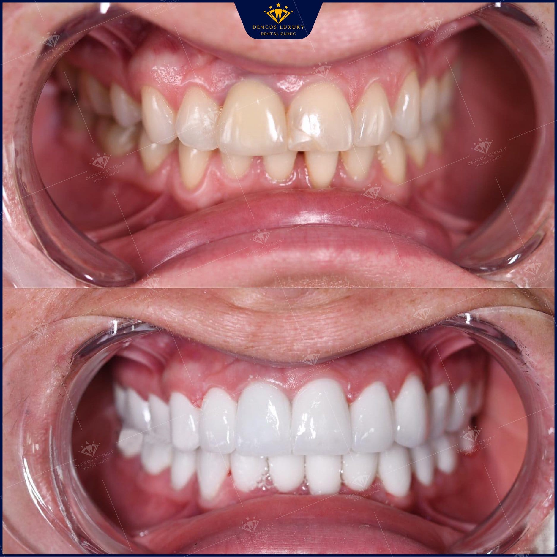 dán sứ veneer