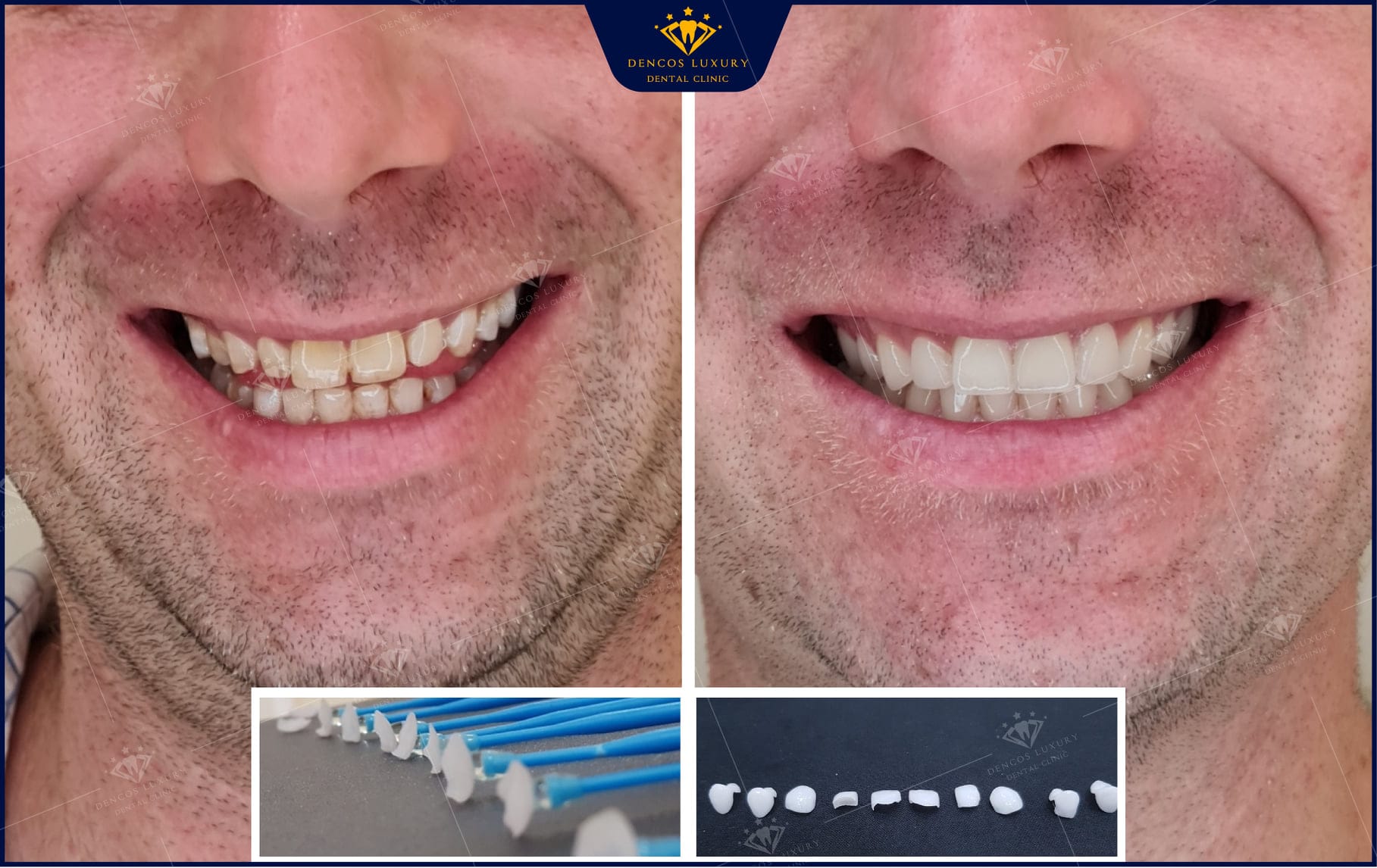 dán sứ veneer