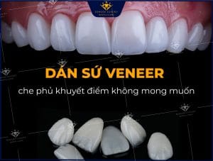dán sứ veneer