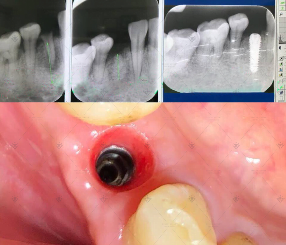 Trồng răng implant